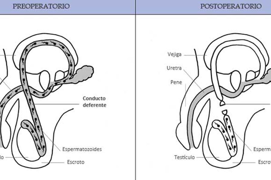 vasectomia1