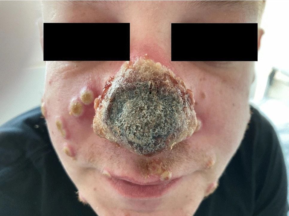 Una nariz que se pudre y erupciones en la boca: pacientes con viruela del mono revelan sus síntomas