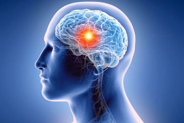 Cáncer de cerebro: estos son los principales síntomas y los tratamientos que se están desarrollando
