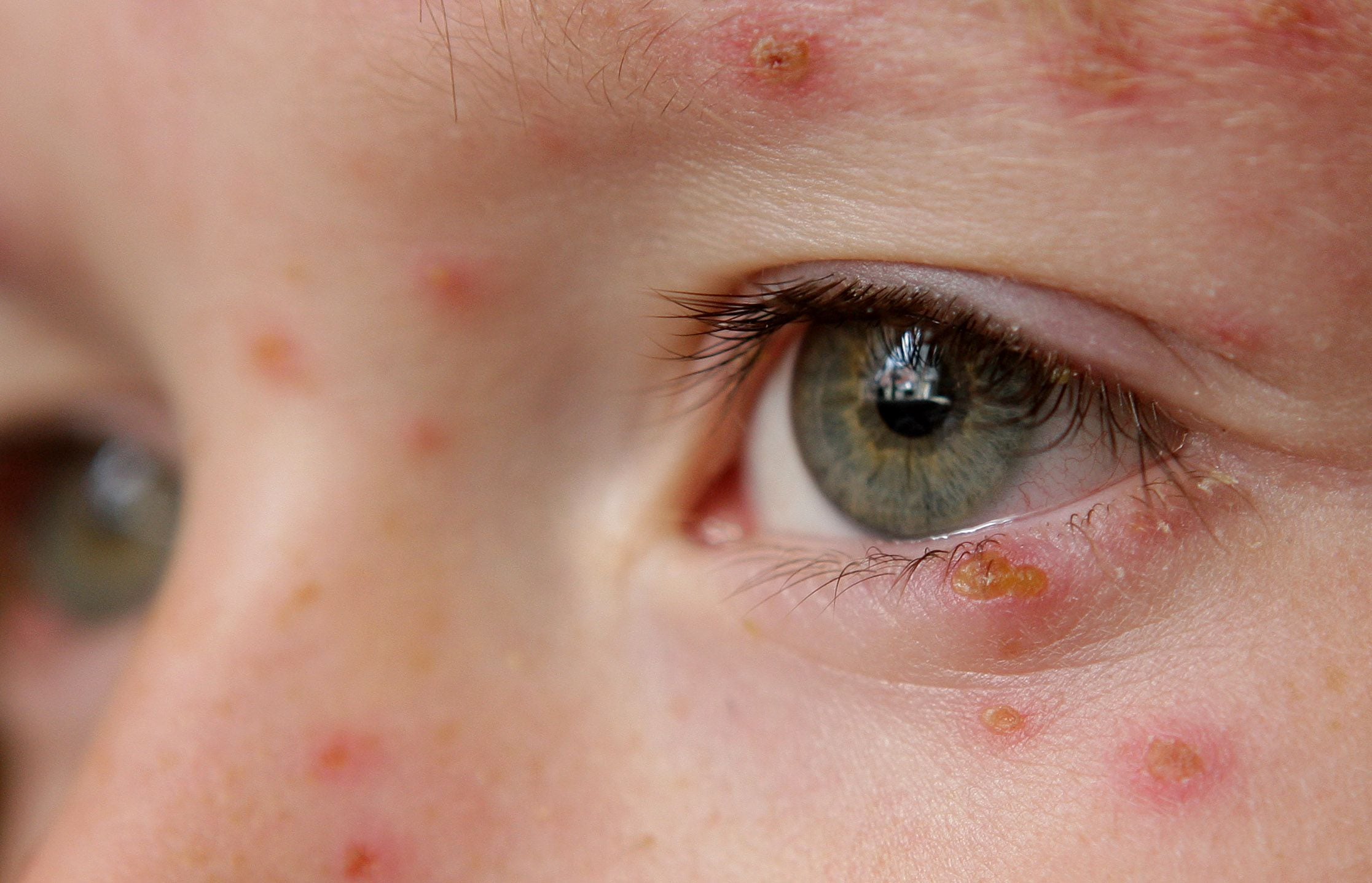 Chicken pox