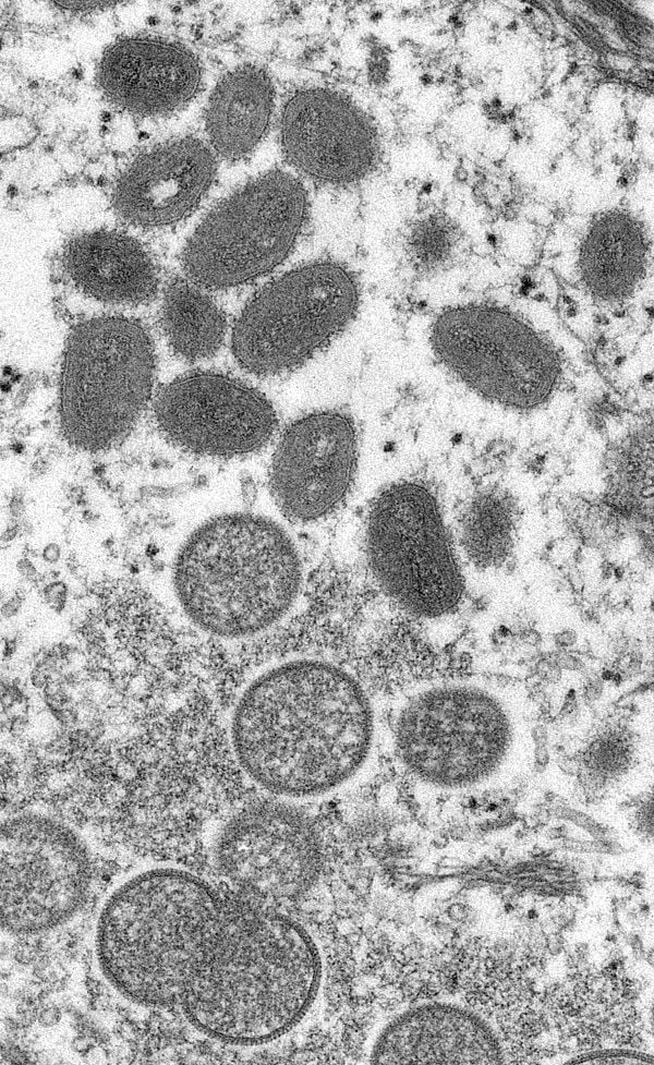 Viruela del mono: ¿Hay casos en Chile? ¿Hay vacuna? ¿Cómo se contagia? Todo lo que sabemos de la enfermedad que se propaga por el mundo