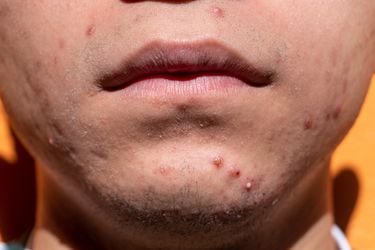 ¿Por qué aparece el acné? Estudio descubre la verdadera razón de la salida de las espinillas