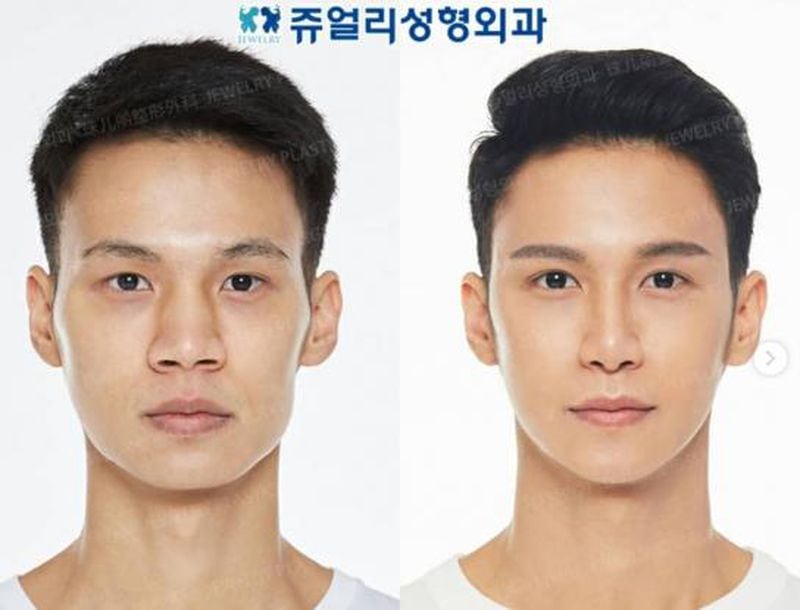 Antes y después de una cirugía practicada en Corea del Sur (Fuente: Instagram/Jewelryps)