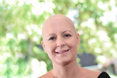 Alopecia femenina, un tabú en alza