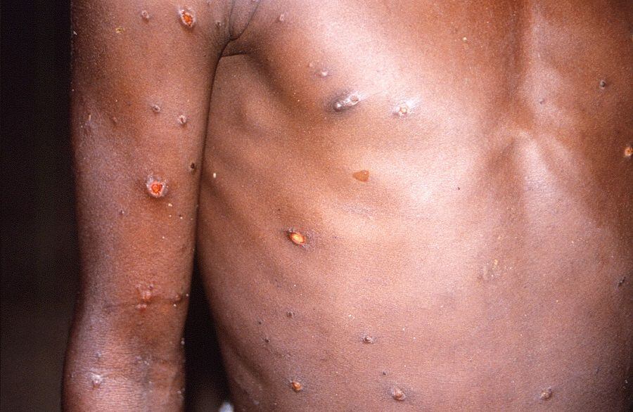 Viruela del mono sigue expandiéndose: ahora detectan casos en Australia, Alemania, Francia y Bélgica