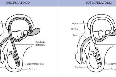 vasectomia1