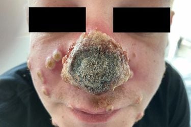 Una nariz que se pudre y erupciones en la boca: pacientes con viruela del mono revelan sus síntomas