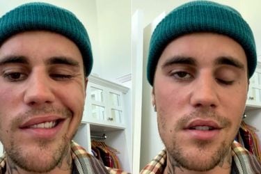 Síndrome de Ramsay Hunt: ¿Qué es el raro trastorno que Justin Bieber dice que le paralizó la cara?