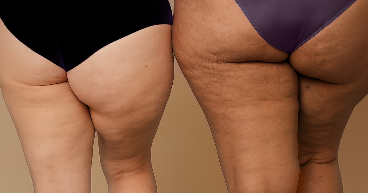 Lipedema: nuevas terapias para aliviar el dolor y mejorar la movilidad