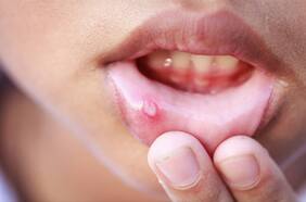 Cuáles son las causas de las aftas y de qué manera prevenir