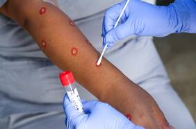 Inusuales síntomas de la viruela del mono están confundiendo a los médicos en el diagnóstico