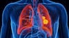 Esta nueva terapia redujo los tumores de cáncer de pulmón y una de sus complicaciones más graves, según un estudio