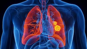 Esta nueva terapia redujo los tumores de cáncer de pulmón y una de sus complicaciones más graves, según un estudio