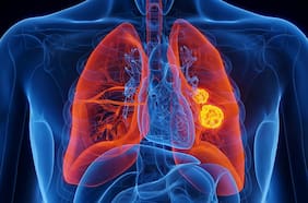 Esta nueva terapia redujo los tumores de cáncer de pulmón y una de sus complicaciones más graves, según un estudio