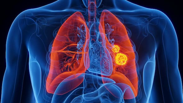 Esta nueva terapia redujo los tumores de cáncer de pulmón y una de sus complicaciones más graves, según un estudio