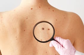 Qué es el melanoma, cuáles son los síntomas y cómo prevenir una de las formas más mortales de cáncer de piel