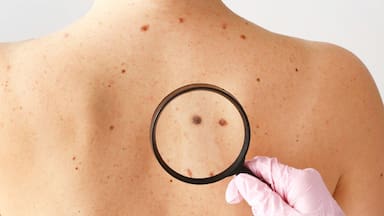 Qué es el melanoma, cuáles son los síntomas y cómo prevenir una de las formas más mortales de cáncer de piel