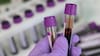 ¿Cómo funciona la primera prueba aprobada por la FDA para saber si tengo alzhéimer?
