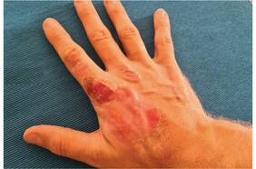 La mano de un superviviente: Grosjean muestra su recuperación