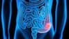 Qué es el cáncer colorrectal, cada vez más común entre adultos jóvenes (y cuáles son sus síntomas)