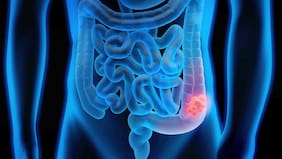 Qué es el cáncer colorrectal, cada vez más común entre adultos jóvenes (y cuáles son sus síntomas)