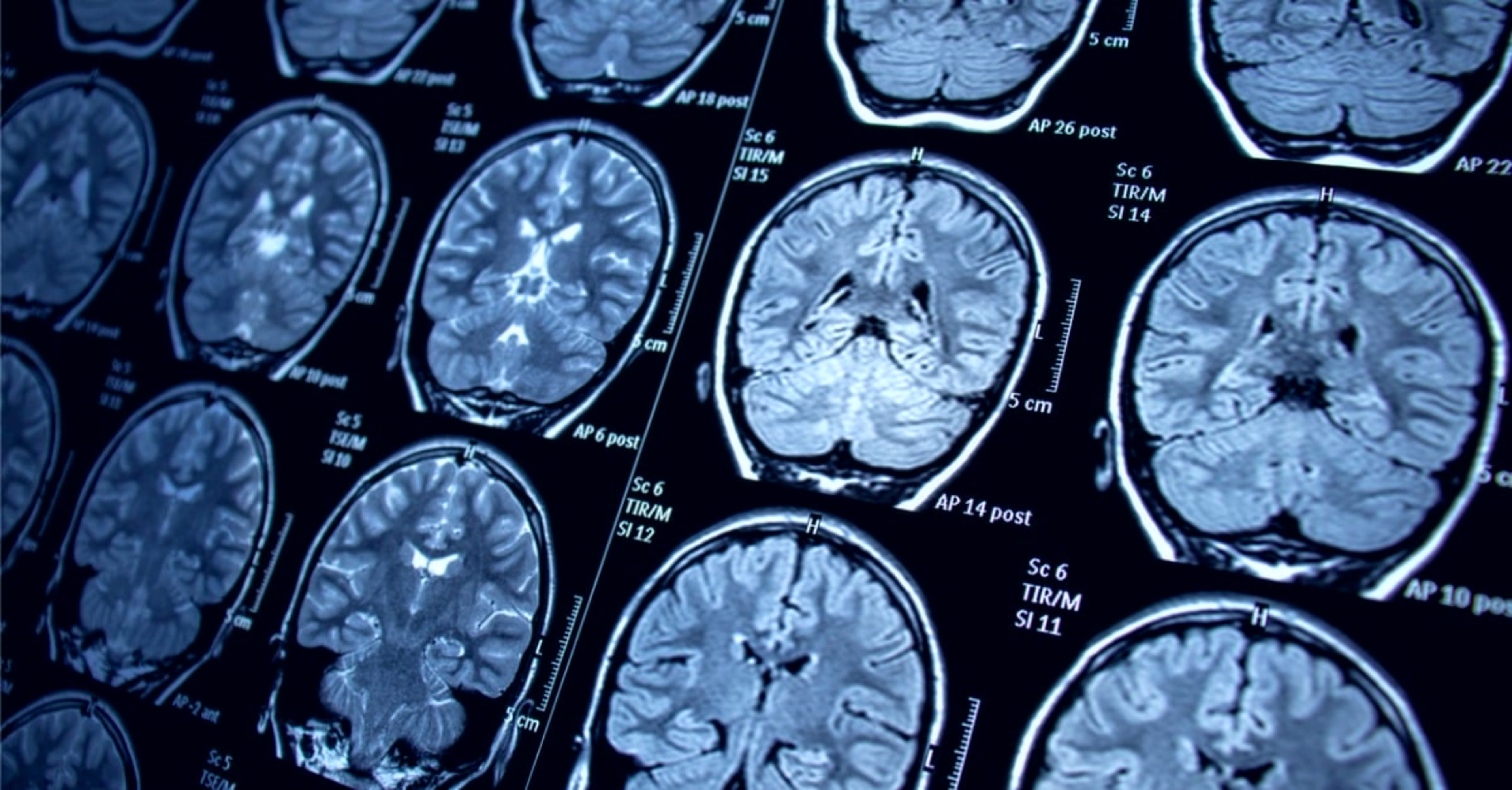 Un “órgano inmunitario” descubierto en el cráneo podría ayudar a combatir el cáncer cerebral, según una investigación. Foto: referencial.