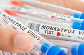 Chile entre los 20 países con más casos de viruela del mono entre naciones que notifican contagios