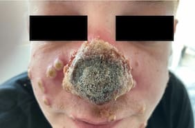 Una nariz que se pudre y erupciones en la boca: pacientes con viruela del mono revelan sus síntomas