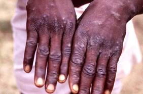 En Perú aseguran que caso sospechoso no se trataría de viruela del mono