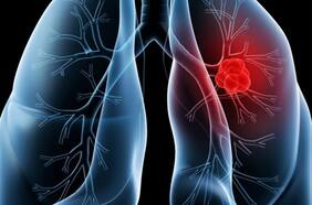 Tratamiento experimental contra el cáncer entra en su última fase, según Moderna y Merck