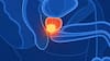 El innovador tratamiento de cáncer de próstata en solo cinco sesiones, liderado por una oncóloga chilena