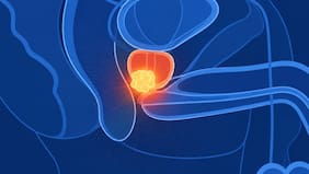 El innovador tratamiento de cáncer de próstata en solo cinco sesiones, liderado por una oncóloga chilena