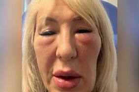 El caso de una mujer que fue “deformada” por un tatuador que se hizo pasar por cirujano estético