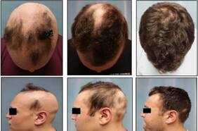 Nueva y prometedora pastilla para la calvicie: casi la mitad de los pacientes recuperaron 80% de su cabello tras un año