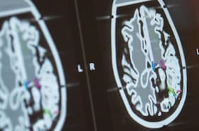 Una de las caras más brutales del coronavirus: médicos chilenos reconocen casos de psicosis post-Covid en el país