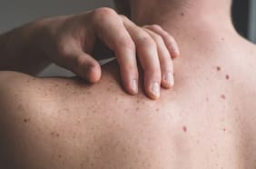 Lunares que hablan: cómo identificar los sospechosos y prevenir el cáncer de piel