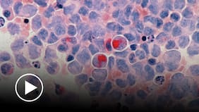 Radar LT | Terapias CAR-T para eliminar la leucemia