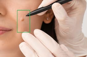 Lunares cancerígenos bajo la lupa de una IA: ¿Cómo detectarlos antes de que sean mortales?