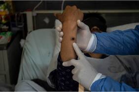 Viruela del mono: OMS declara emergencia sanitaria internacional