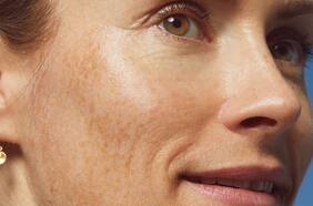 ¿Cómo cuidar la piel después del verano?