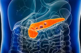 Qué es Daraxonrasib, el prometedor fármaco contra el cáncer de páncreas disponible para algunos pacientes terminales