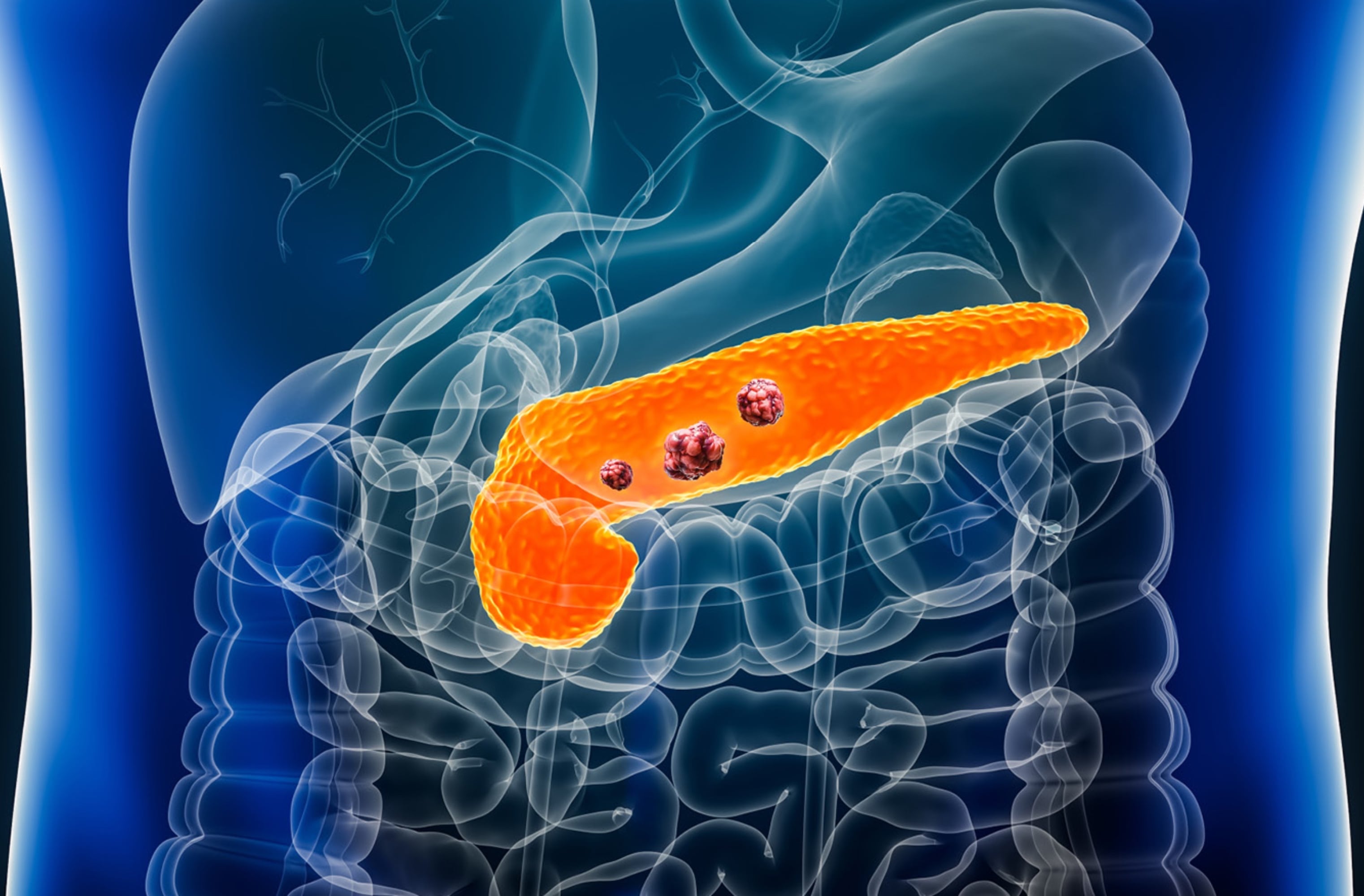 Un ensayo clínico encontró un beneficio inesperado de la vitamina D en el cáncer de páncreas