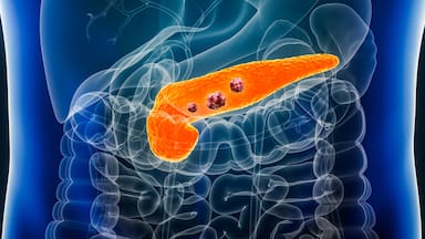 Qué es Daraxonrasib, el prometedor fármaco contra el cáncer de páncreas disponible para algunos pacientes terminales