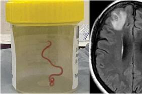 “Todo el mundo quedó en shock”: encuentran por primera vez un gusano vivo en el cerebro de una mujer