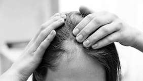 Un fármaco para la artritis logró restaurar hasta el 100% del cabello en pacientes con alopecia severa