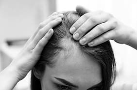 Un fármaco para la artritis logró restaurar hasta el 100% del cabello en pacientes con alopecia severa