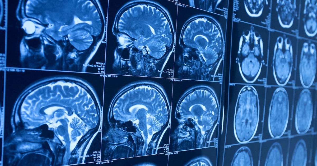 Científicos desarrollan una vacuna contra tumores cerebrales que mostró resultados prometedores en un ensayo clínico - La Tercera