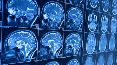 Un “órgano inmunitario” descubierto en el cráneo podría ayudar a combatir el cáncer cerebral, según una investigación