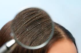 Por qué sale caspa y de qué forma solucionarla