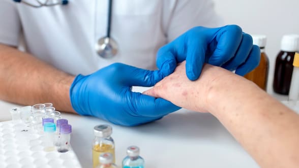 Qué es la lepra, la enfermedad que se eliminó como problema de salud pública en Chile